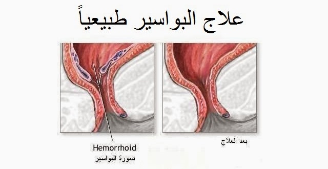 علاج البواسير بالثلج , كيفية معالجة البواسير بالثلج