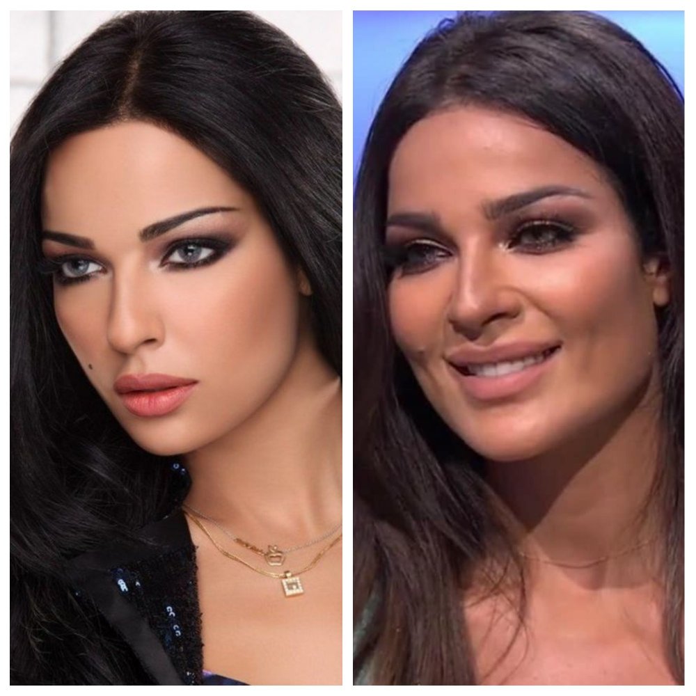 عمليات تجميل الفك , تعرف على تجميل الفك