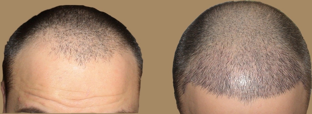 زراعة الشعر بالمغرب، افضل الاماكن في زراعة الشعر 7182 3