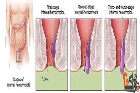 علاج البواسير - اقوي علاج للبواسير 3438 3