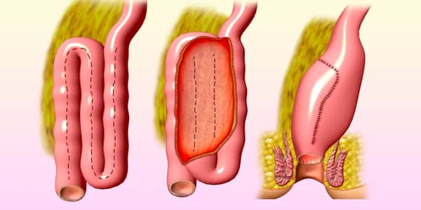 علاج التهاب الامعاء , طرق علاج التهاب الامعاء