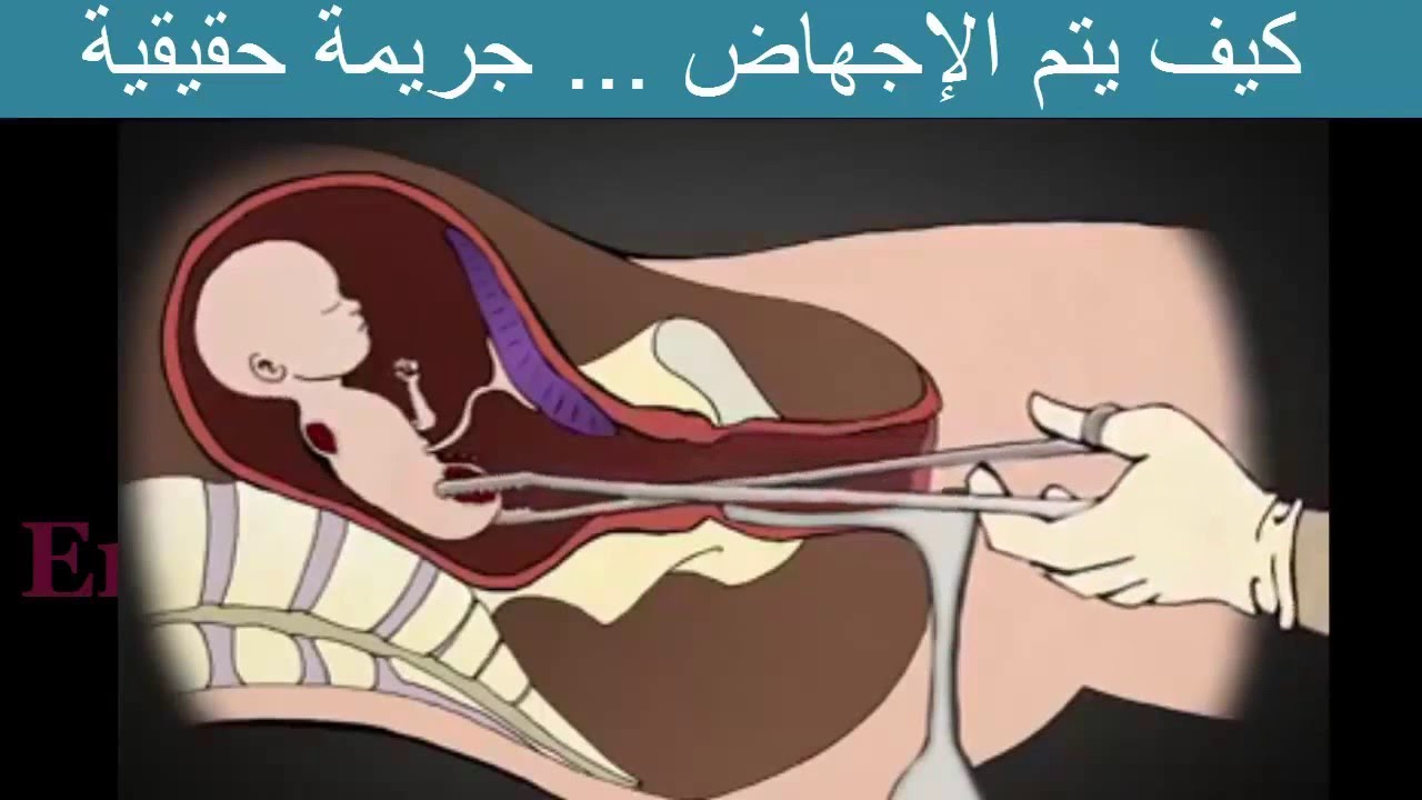 حركات للاجهاض ٫افظع مخاطر وحركات الاجهاض 983 2