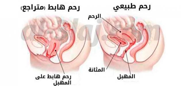 اسباب هبوط الرحم - ماهي اسباب هبوط الرحم 7988 2