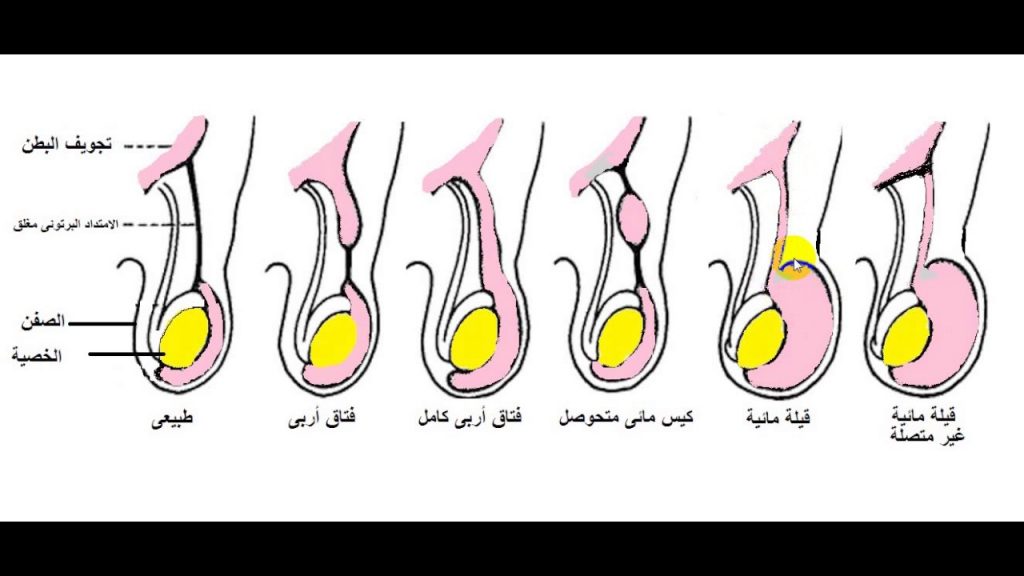 الخصية المعلقة عند الاطفال بالصور , المرض الاكثر شيوعا عند ابناء السابع