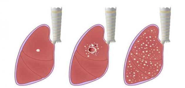 علاج السل الرئوي , مرض خطير جدا