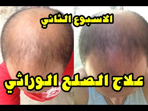 علاج تساقط الشعر - افضل علاج للشعر 147 2